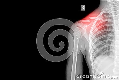 Right Shoulder Xray AP views Showing fracture cavicle on red mark Stock Photo