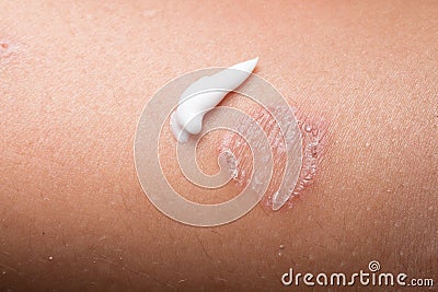 Ring Worm infection, Dermatophytosis Stock Photo