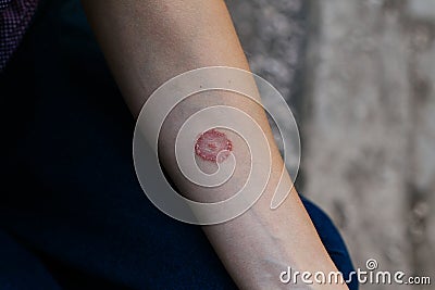 Ring Worm infection, Dermatophytosis on skin. Applying an emollient to dry flaky skin Stock Photo