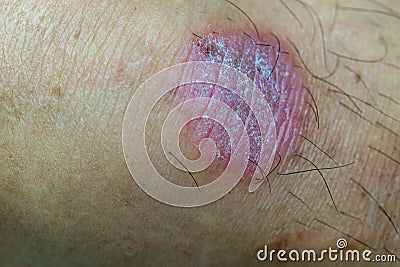 Ring Worm infection, Dermatophytosis on skin. Ringworm infection or Tinea on skin. Mycosis infection on the human skin. Stock Photo