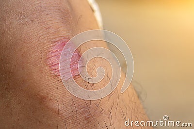 Ring Worm infection, Dermatophytosis on skin. Ringworm infection or Tinea on skin. Mycosis infection on the human skin. Stock Photo
