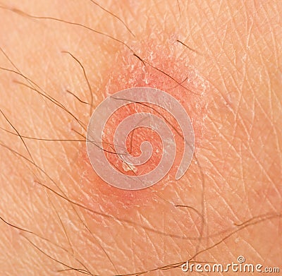 Ringworm on human skin Stock Photo