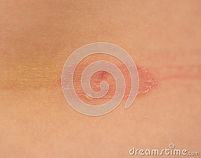 Ringworm of the skin. macro Stock Photo