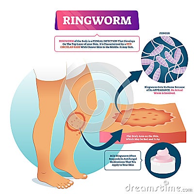 Ringworm vector illustration. Labeled fungal skin infection example scheme. Vector Illustration