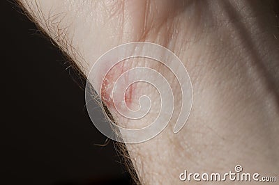 Ringworm on white man / Mycosis Stock Photo