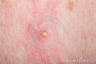 Ripe pimple on the inflamed reddened skin. Stock Photo