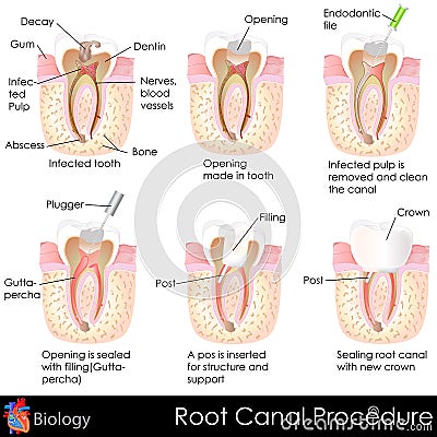 Root Canal Procedure Vector Illustration