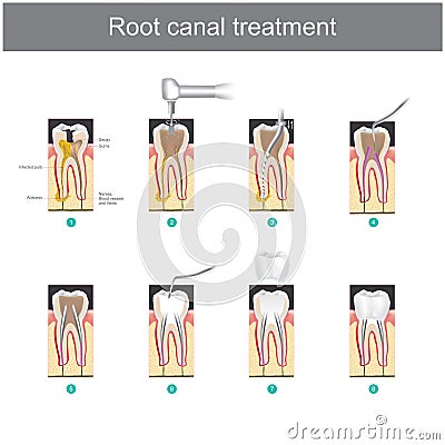 Root canal treatment. How to treat our teeth Stock Photo