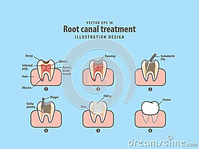 Root canal treatment illustration vector on blue background. Vector Illustration