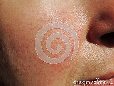 Rosacea on face of middle aged woman Stock Photo