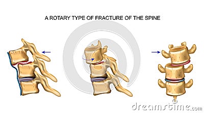 Rotational type of vertebral fracture Vector Illustration