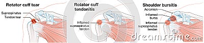 Rotator cuff tear, rotator cuff tendonitis, shoulder bursitis Cartoon Illustration