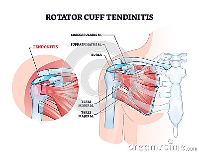 Rotator cuff tendinitis as shoulder muscular inflammation outline diagram Vector Illustration