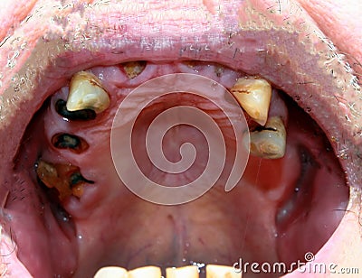 Rotten bad teeth. Caries. Periodontal disease. Dental. Stock Photo