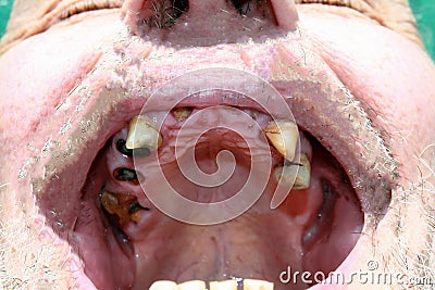 Rotten bad teeth. Caries. Periodontal disease. Dental. Stock Photo