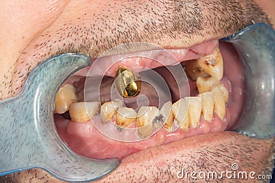 Rotten teeth, caries and plaque close-up in an asocially ill patient. The concept of poor hygiene and health problems Stock Photo