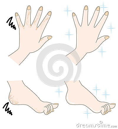 Rough skin of hand and foot Vector Illustration