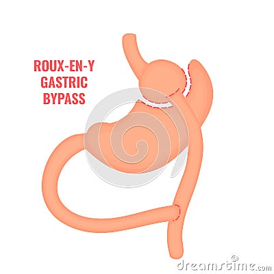 Roux-en-y gastric bypass bariatric surgery weight loss infographics Vector Illustration