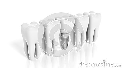 Row of teeth and dental implant Stock Photo