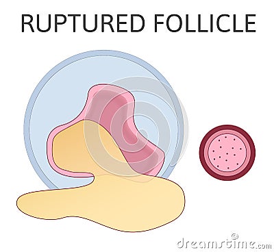 Ruptured follicle. Stage of developing follicle. Ovulation Cartoon Illustration