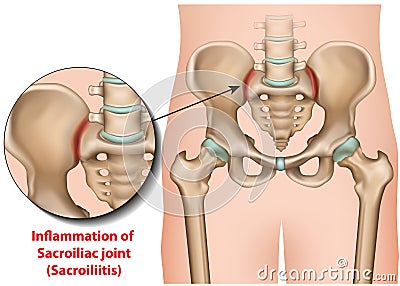 Sacroiliac joint inflammation 3d medical illustration sacroiliitis Cartoon Illustration