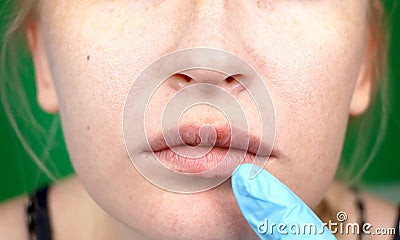 Herpes on the lips, part of a woman`s face with finger on lips with herpes, beauty concept Stock Photo