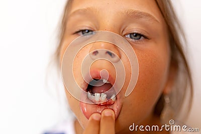 Sad, tired little girl pull off lip to show toothless mouth, fresh wound bleeding after tooth extraction. Dentist treat Stock Photo