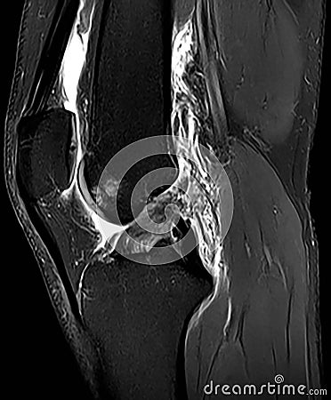 Sagital PD FS MRI of Knee Stock Photo