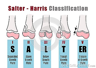 Salter - Harris classification to to recognize and identify different types of bone fractures Stock Photo