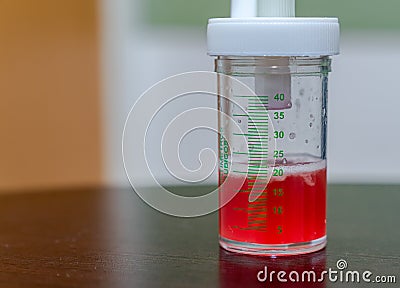 Sample of bronchial lavage after bronchoscopy of a patient Stock Photo