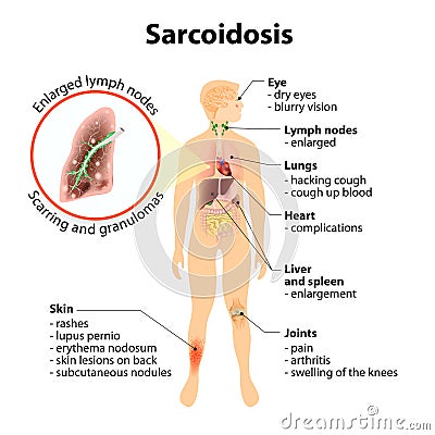 sarcoidosis pictures