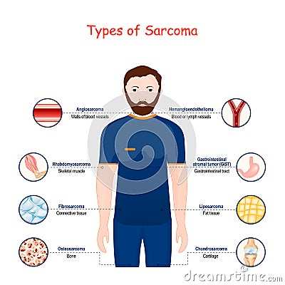 Sarcoma. Types of a malignant tumor. cancer Vector Illustration