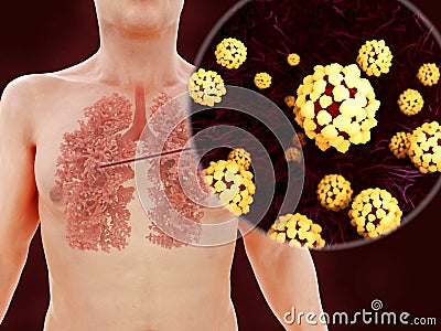 Sars disease, coronaviruses in the lung Stock Photo