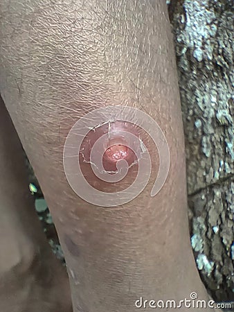 Scabies on the legs of someone who is already wrinkled Stock Photo