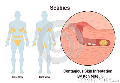Scabies. Skin infestation with itch mite. Infected microscopic epidermis Cartoon Illustration