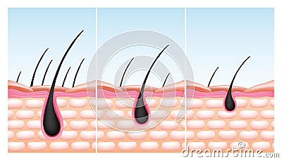 Scalp skin. Hair root reduce. Bulb or follicle fall. Baldness and growth structure. Nutrition drops treatment. Grow Vector Illustration