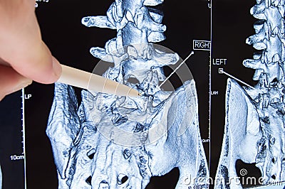 Scan of lumbosacral spine. Doctor pointed on area of lumbar, where pathology is detected, such as radiculitis, radiculopathy, hern Stock Photo