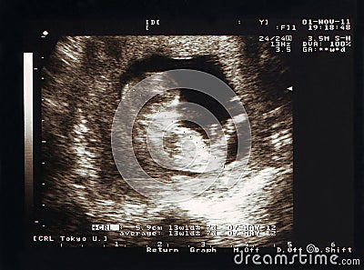 Scan on pregnancy, foetus Stock Photo