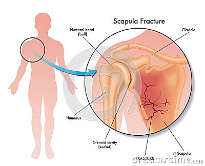 Scapula fracture illustration Vector Illustration