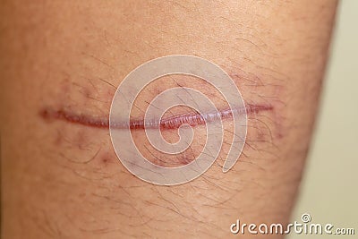 A scar of fibrous tissue that replaces normal skin after an injury on skin. Stock Photo