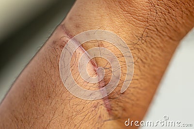 A scar of fibrous tissue that replaces normal skin after an injury on skin. Stock Photo