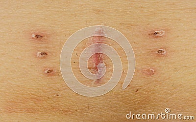 Scar with bruise closeup after hysterectomy Stock Photo