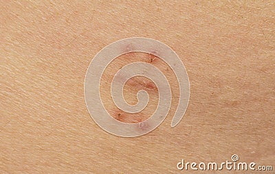 Scar with bruise closeup after hysterectomy Stock Photo