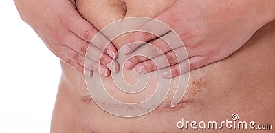 Scar after a Caesarean section, Bikini line Stock Photo