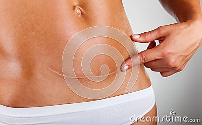 Scar of caesarean section Stock Photo