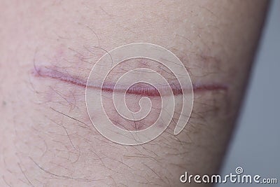 A scar of fibrous tissue that replaces normal skin after an injury on skin. Stock Photo