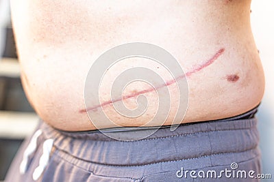 Scar on human skin scar or scar after kidney surgery Stock Photo
