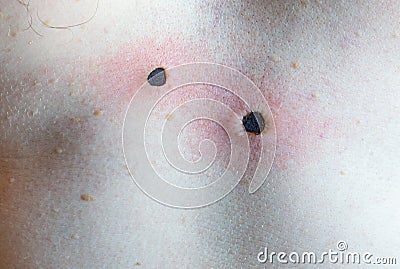 Scar from laser mole removal. Stock Photo