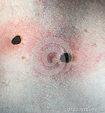 Scar from laser mole removal. Stock Photo