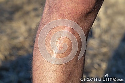 Scar on the leg, after injury. The last stage of wound healing, scarring. Skin trauma, wound change during healing Stock Photo